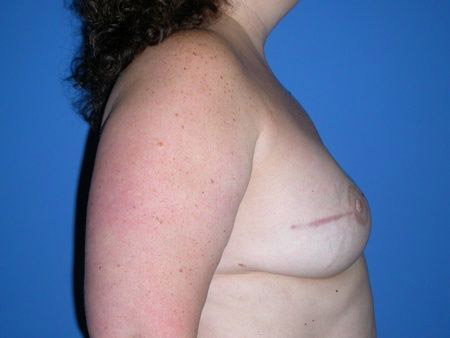 breast reconstruction