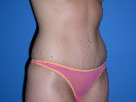 after abdominoplasty