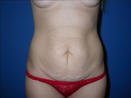 before abdominoplasty