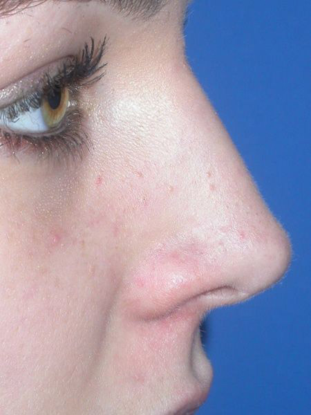 Rhinoplasty