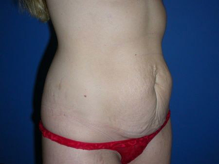 before abdominoplasty