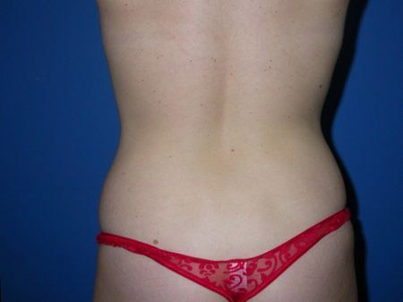 before abdominoplasty